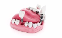  "Dentala Studija" SIA - zobu implanti 10