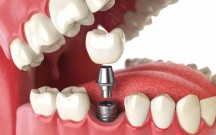  "Dentala Studija" SIA - zobu implanti 11