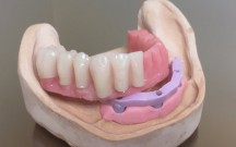  "Dentala Studija" SIA - zobu implanti 1